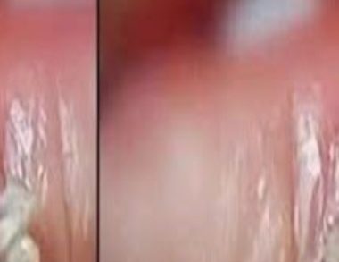 10 natural remedies to remove warts at home safe and effective solutions