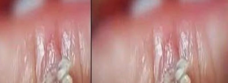 10 natural remedies to remove warts at home safe and effective solutions