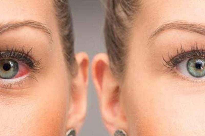 castor oil for eye health natural remedies for dry eyes eye bags and more
