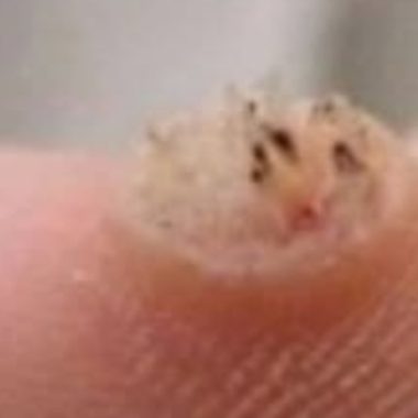 effective natural remedies for wart removal apple cider vinegar garlic and more