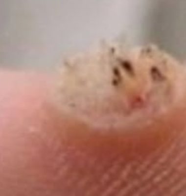 effective natural remedies for wart removal apple cider vinegar garlic and more