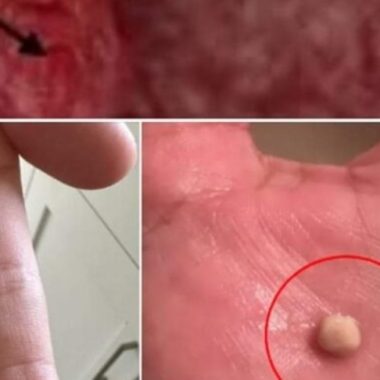 how to get rid of tonsil stones naturally causes symptoms and home remedies