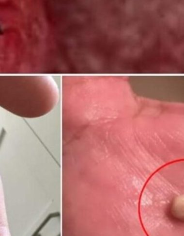 how to get rid of tonsil stones naturally causes symptoms and home remedies