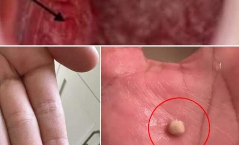 how to get rid of tonsil stones naturally causes symptoms and home remedies