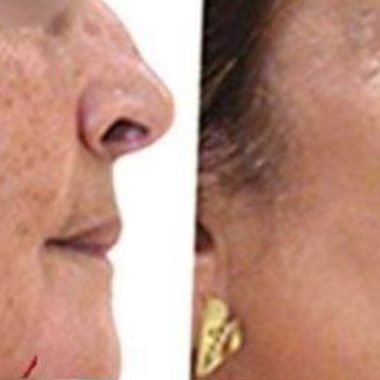 how to naturally fade age spots with baking soda a simple diy remedy