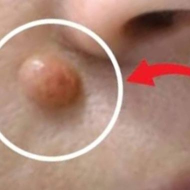 how to remove warts naturally with apple cider vinegar in 24 hours