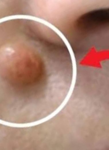 how to remove warts naturally with apple cider vinegar in 24 hours