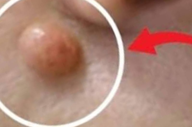 how to remove warts naturally with apple cider vinegar in 24 hours