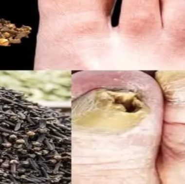 natural clove oil remedy for nail fungus a comprehensive guide to healthy nails
