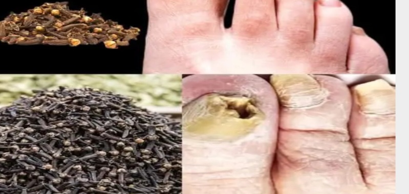 natural clove oil remedy for nail fungus a comprehensive guide to healthy nails