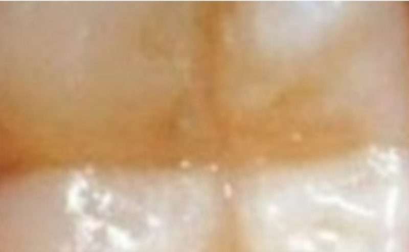 natural dental health prevent cavities with a balanced diet and smart food choices