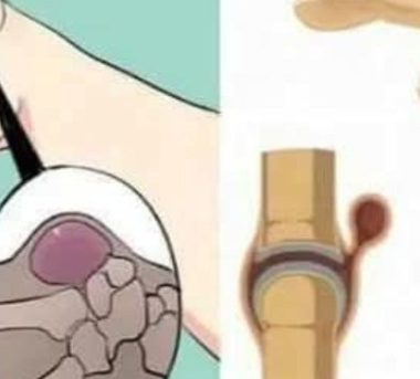 natural relief for varicose veins cabbage leaf compress therapy