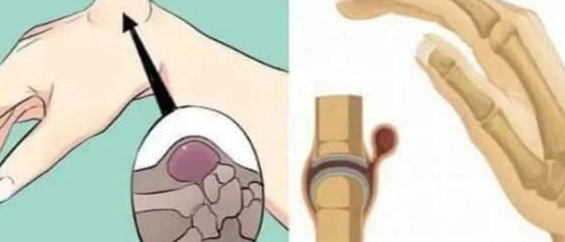 natural relief for varicose veins cabbage leaf compress therapy