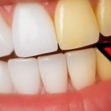 natural teeth whitening with ginger and salt fresh breath remedy