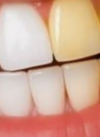 natural teeth whitening with ginger and salt fresh breath remedy