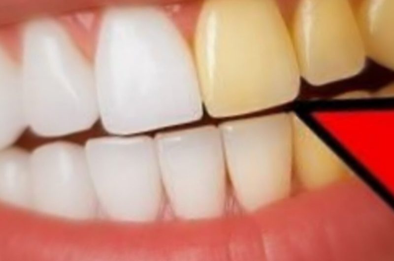 natural teeth whitening with ginger and salt fresh breath remedy
