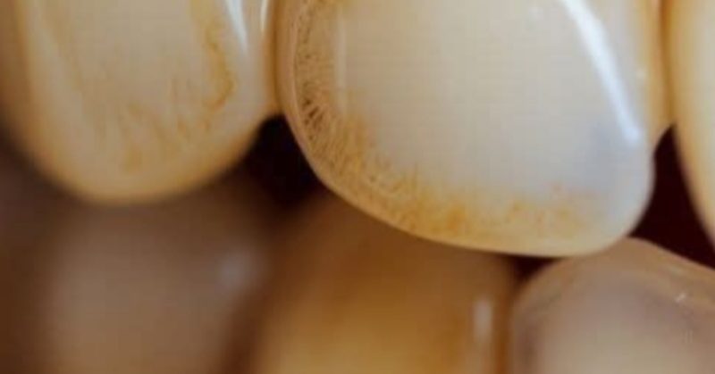 natural ways to remove tartar and whiten teeth at home dentist approved tips