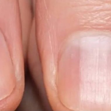 striped nails what they could reveal about your health
