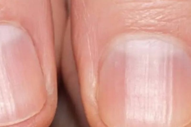 striped nails what they could reveal about your health