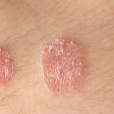 understanding psoriasis types causes and effective management strategies