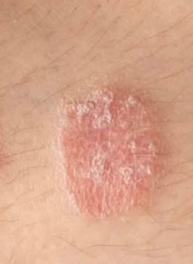 understanding psoriasis types causes and effective management strategies