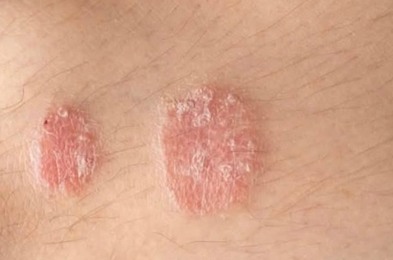 understanding psoriasis types causes and effective management strategies