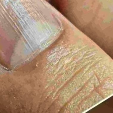 vertical lines on nails causes nutrient deficiencies and when to see a doctor