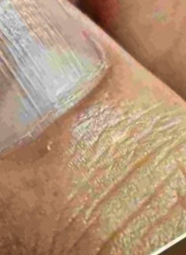 vertical lines on nails causes nutrient deficiencies and when to see a doctor