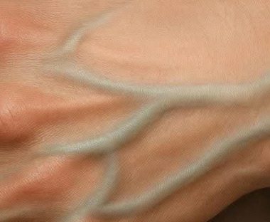 why do some people have visible veins understanding the causes and when to seek help