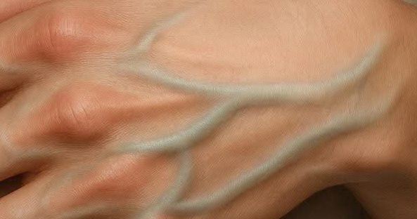 why do some people have visible veins understanding the causes and when to seek help